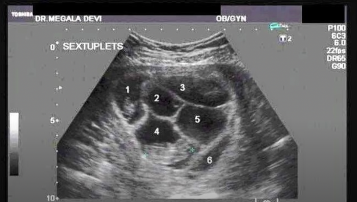 Ultrasound of Laura Perkins' womb showing sextuplets, Photo Credit: Did You Know